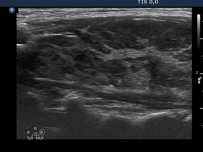Right lobe, longitudinal scan