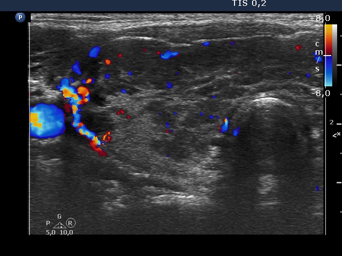 Right lobe, longitudinal scan