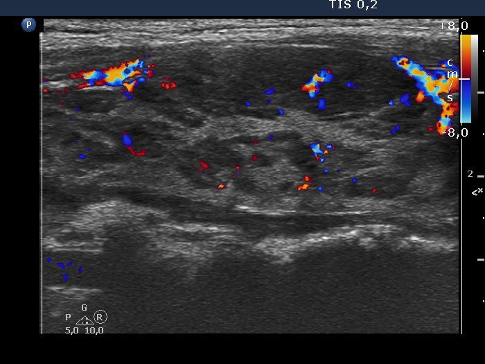 Right lobe, longitudinal scan