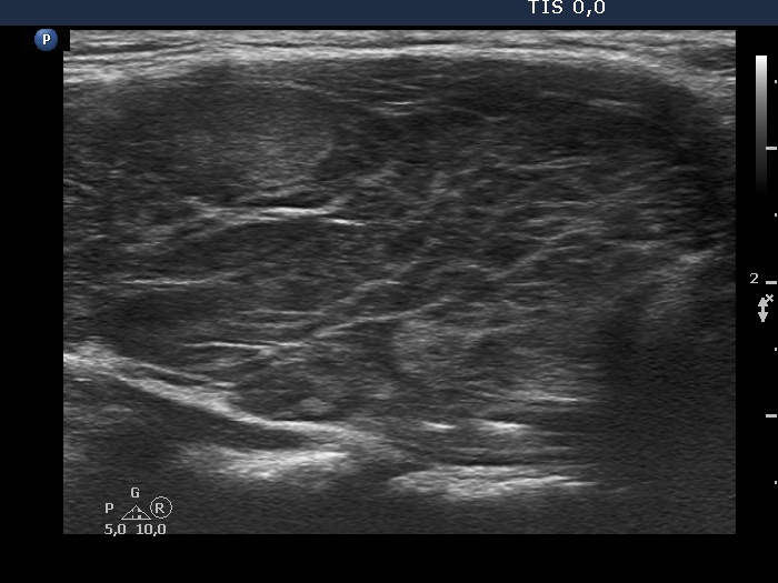 Right lobe, longitudinal scan