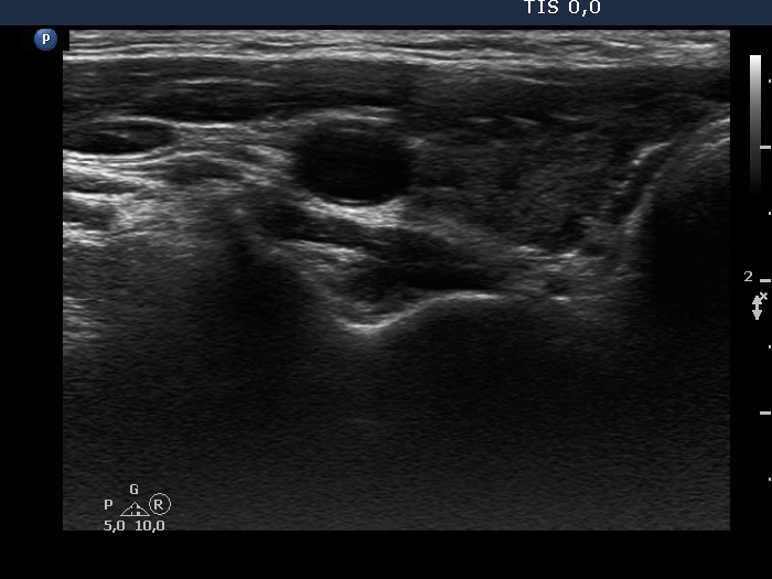 Right lobe, longitudinal scan