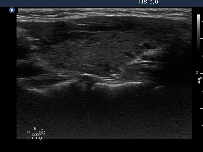 Right lobe, longitudinal scan