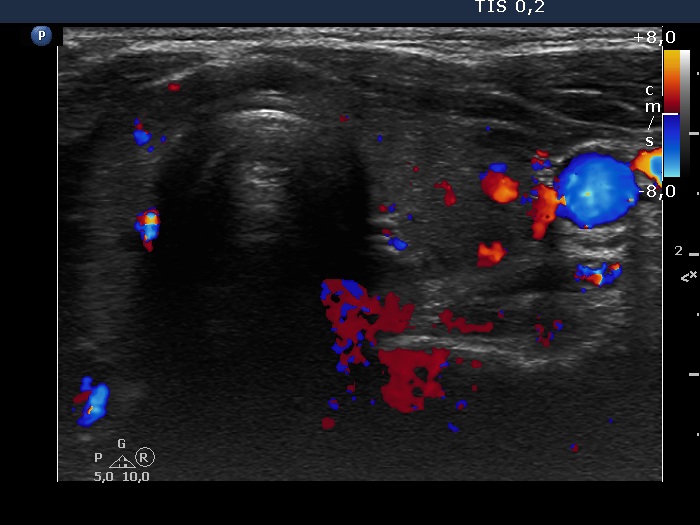 Right lobe, longitudinal scan