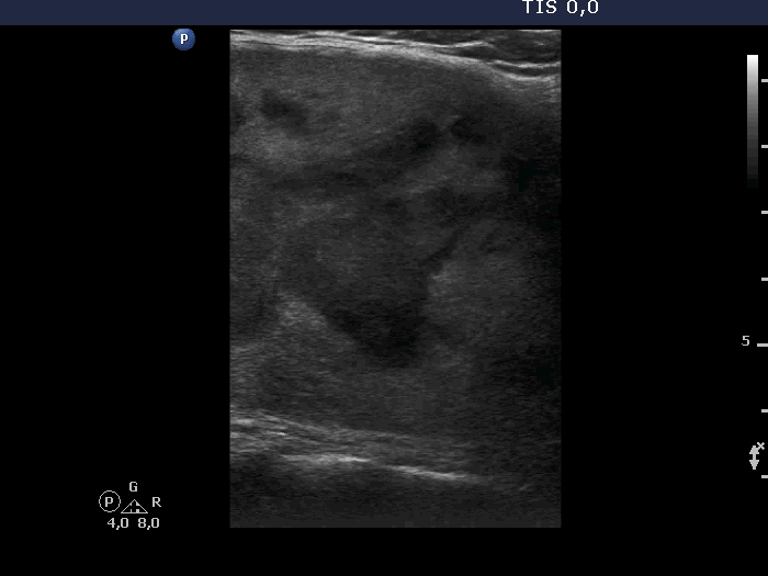 Right lobe, longitudinal scan