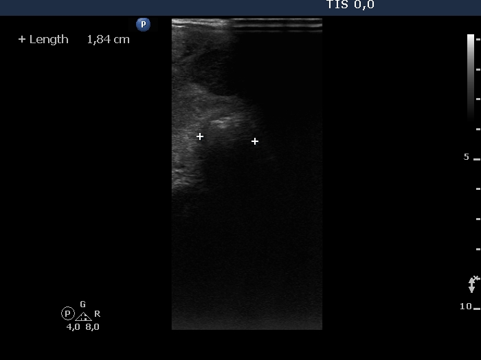Right lobe, longitudinal scan