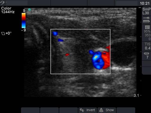 Right lobe, longitudinal scan