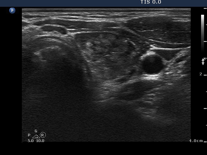 Right lobe, horizontal view