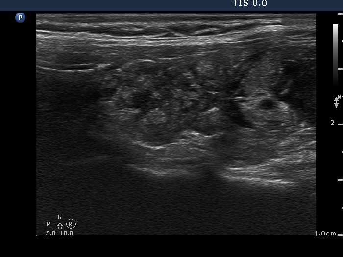 Right lobe, horizontal view