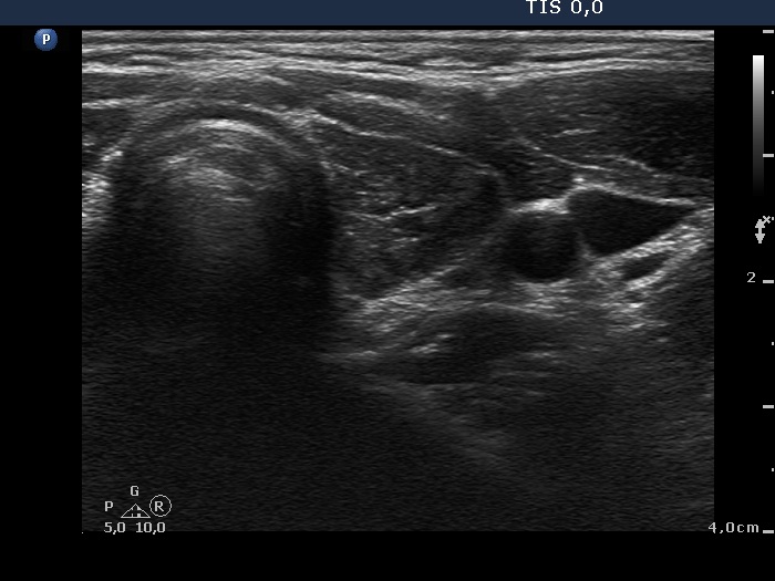 Right lobe, horizontal view