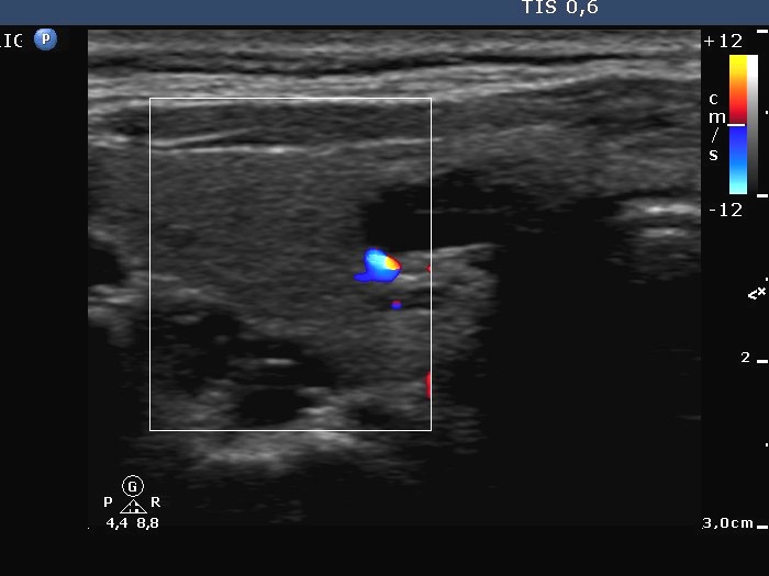 Right lobe, longitudinal scan