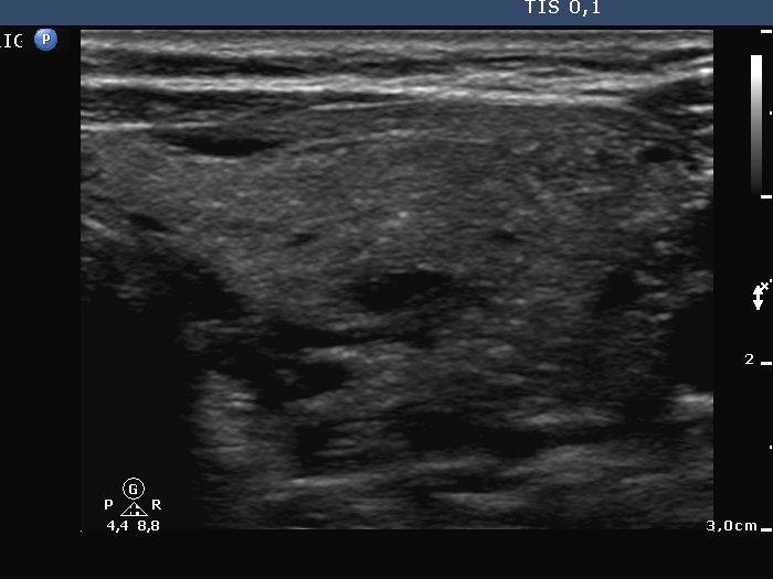 Right lobe, longitudinal scan