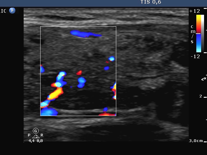 Right lobe, longitudinal scan