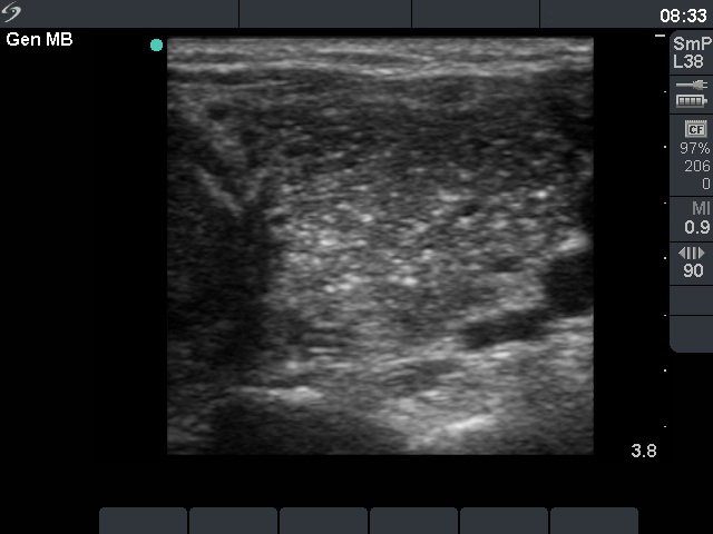 Right lobe, longitudinal scan