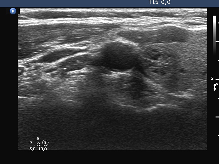 Right lobe, longitudinal scan