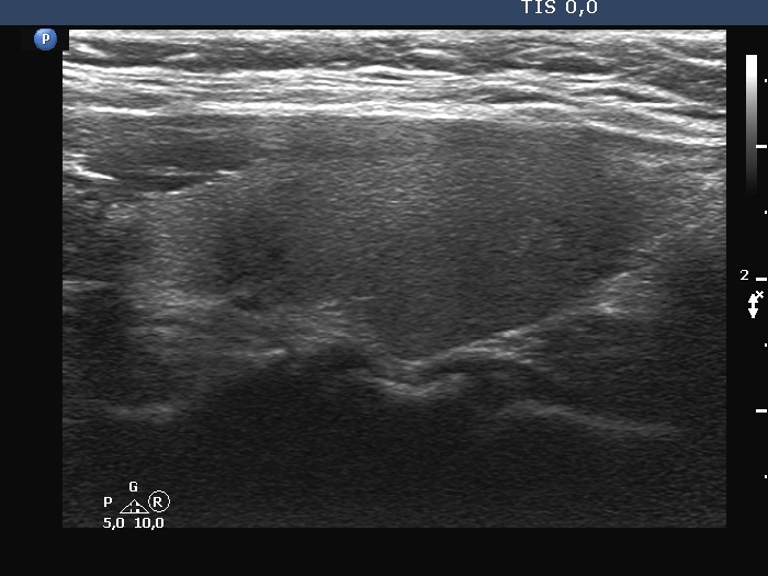 Right lobe, longitudinal scan