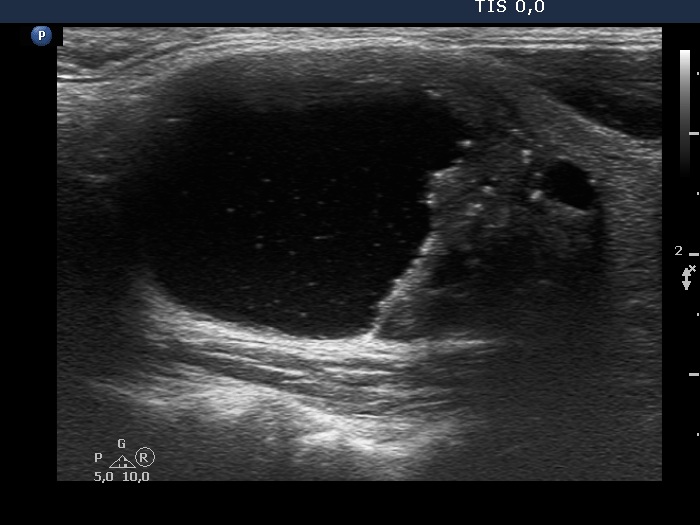 Right lobe, longitudinal scan