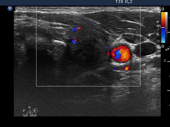 Right lobe, longitudinal scan