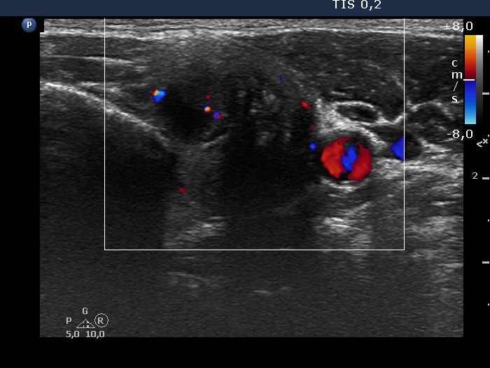 Right lobe, longitudinal scan