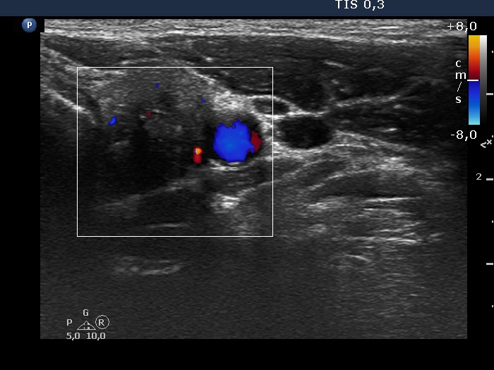 Right lobe, longitudinal scan
