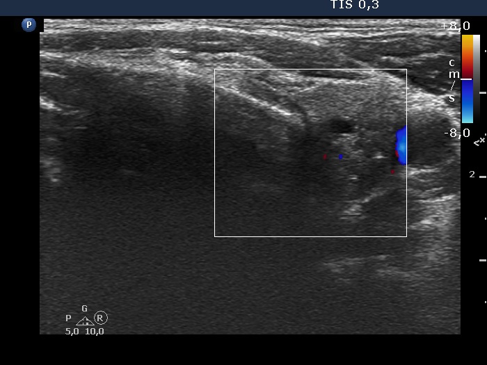 Right lobe, longitudinal scan