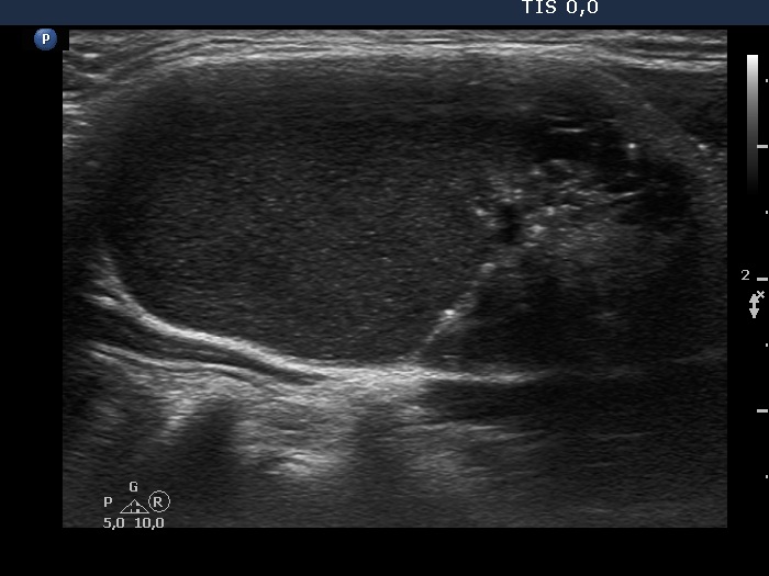 Right lobe, longitudinal scan