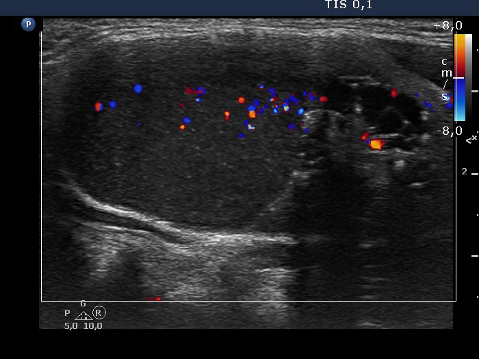 Right lobe, longitudinal scan