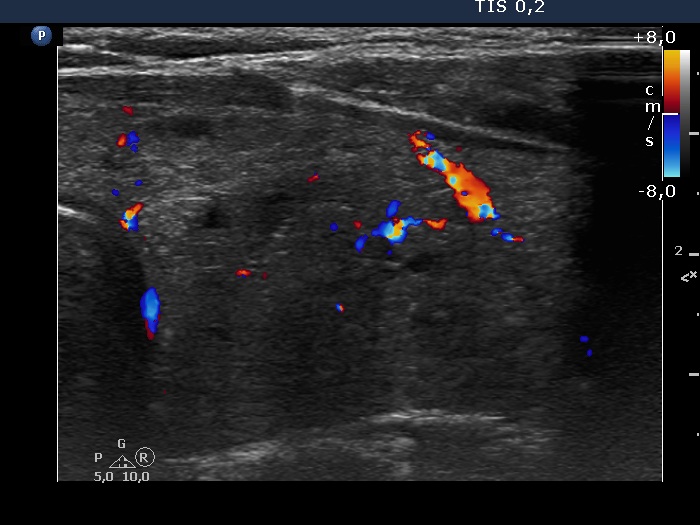 Right lobe, longitudinal scan