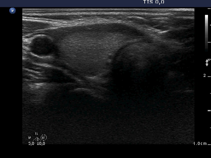 Right lobe, longitudinal scan