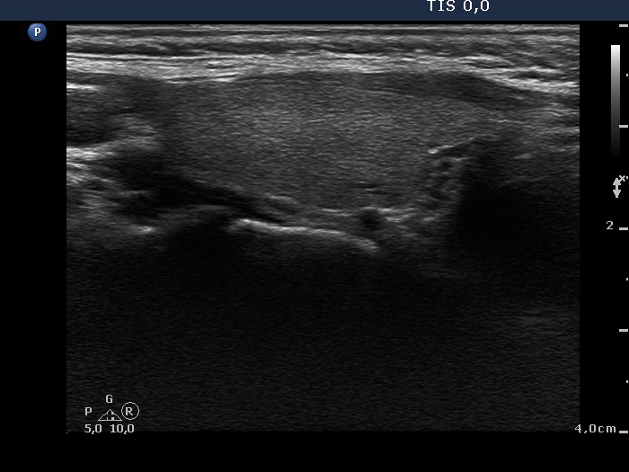 Right lobe, longitudinal scan