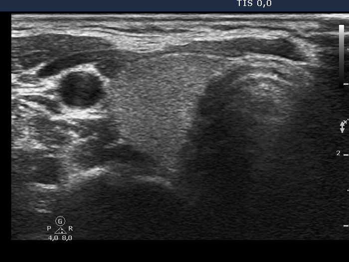 Right lobe, horizontal view