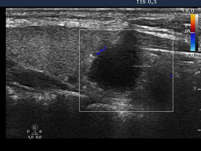 Right lobe, longitudinal scan