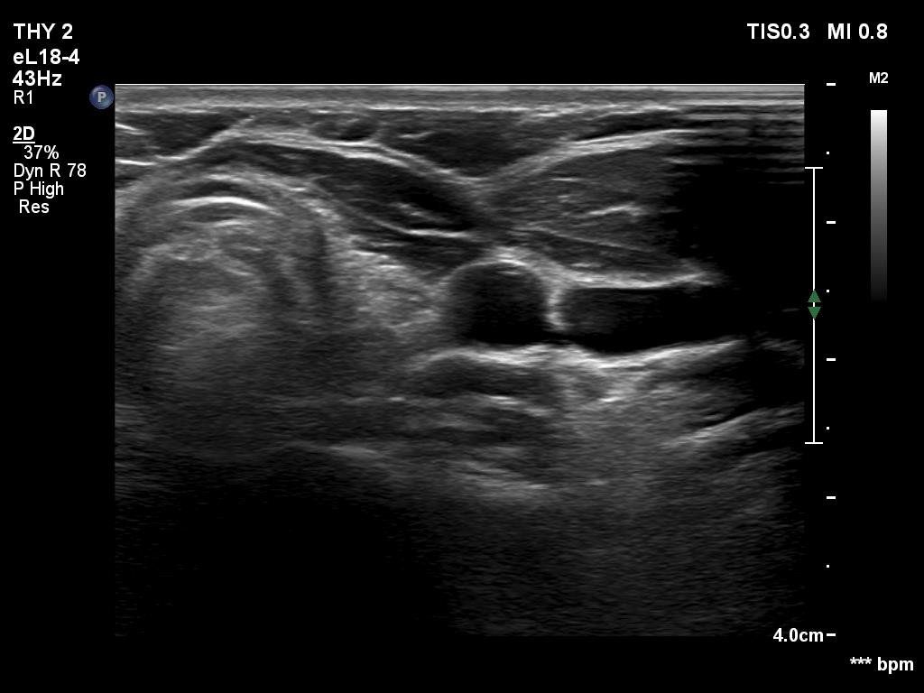 Right lobe, longitudinal scan