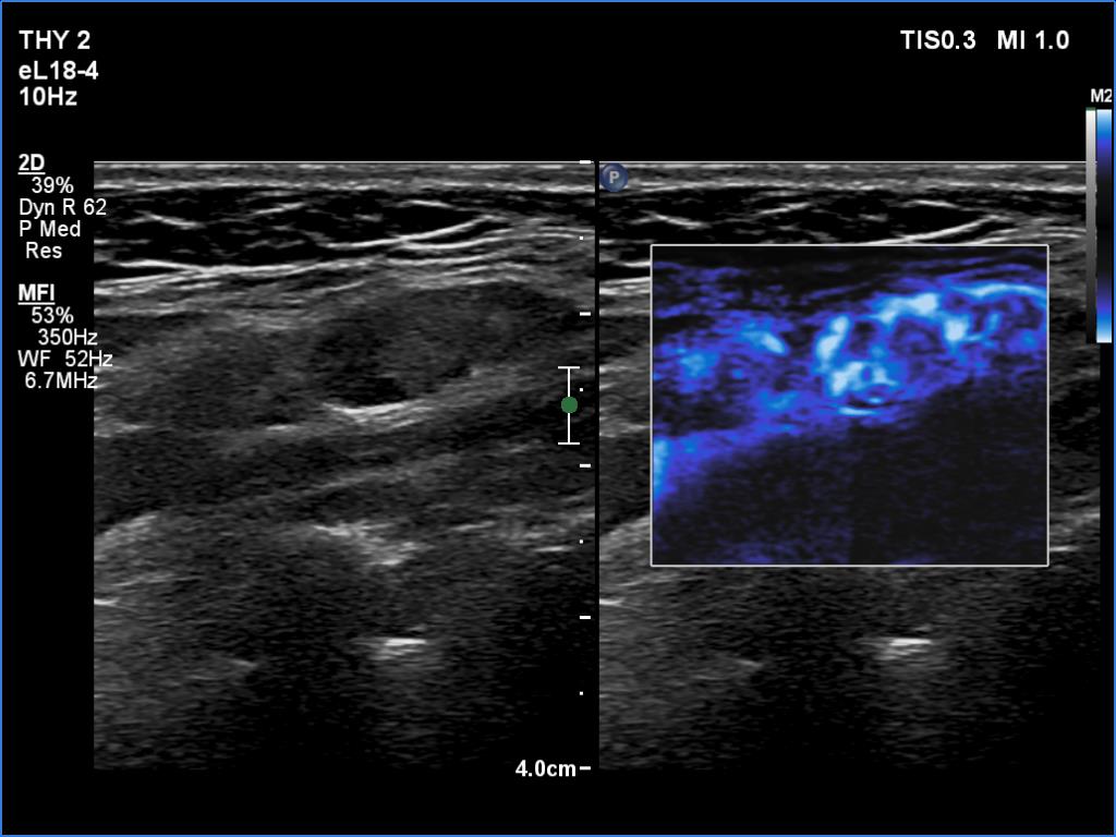 Right lobe, longitudinal scan