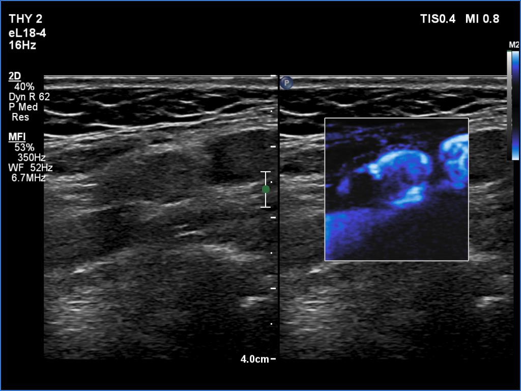 Right lobe, longitudinal scan