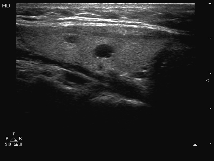 Right lobe, longitudinal scan