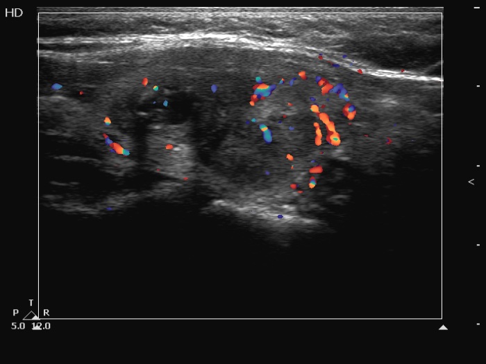Right lobe, longitudinal scan