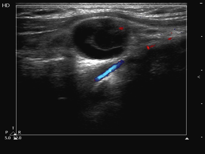 Right lobe, longitudinal scan