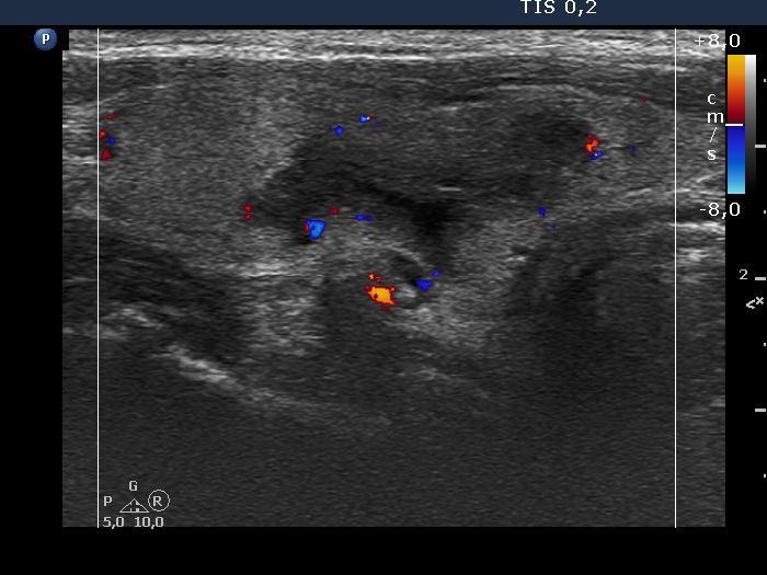 Right lobe, longitudinal scan