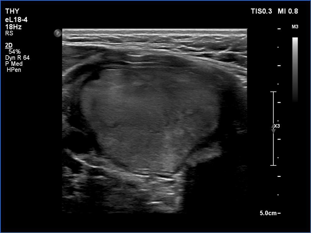 Right lobe, longitudinal scan