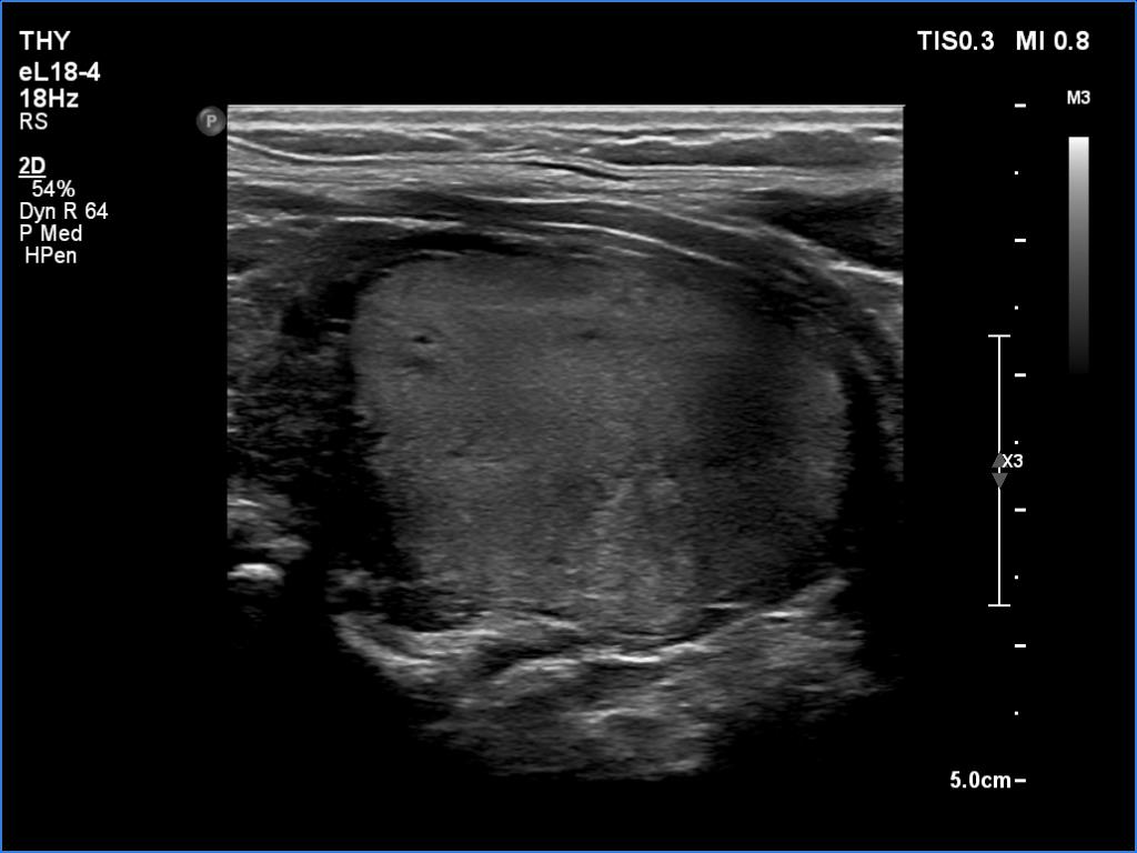 Right lobe, longitudinal scan
