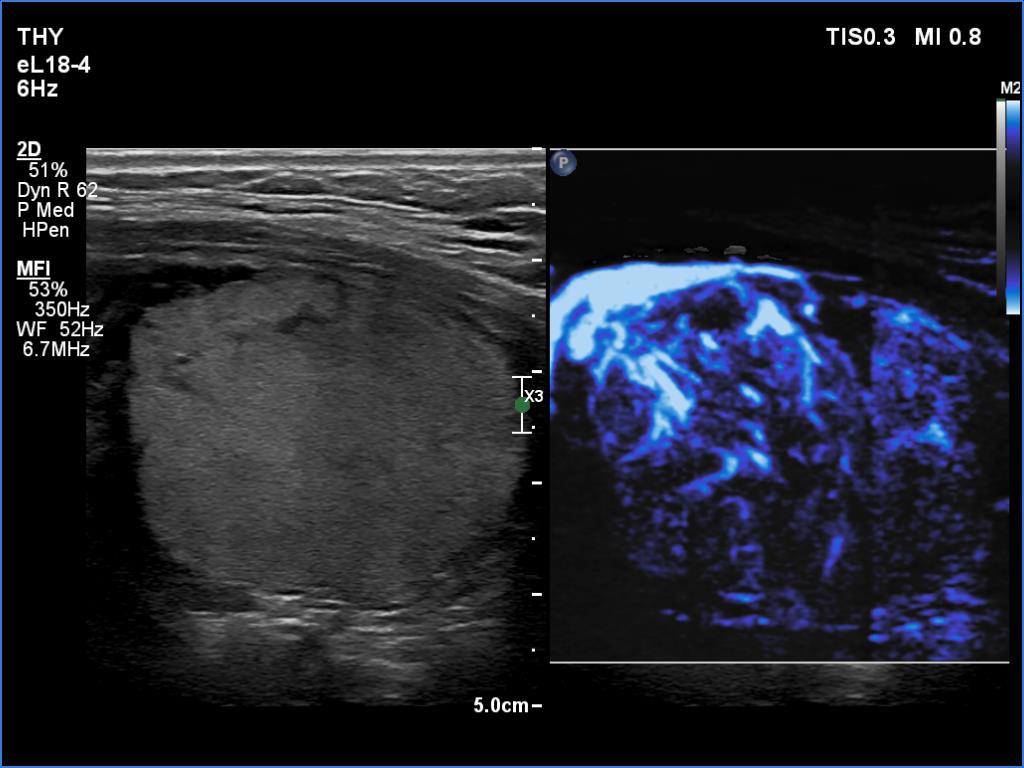 Right lobe, longitudinal scan
