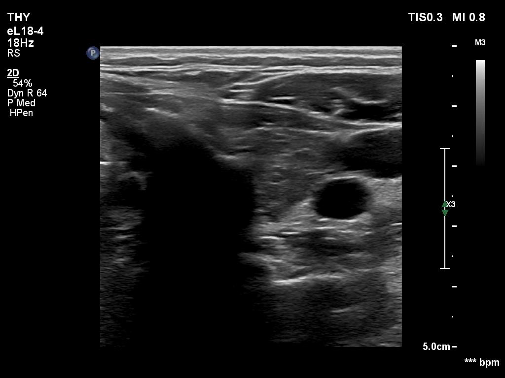 Right lobe, longitudinal scan
