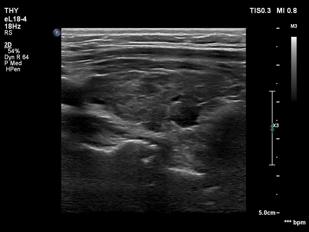 Right lobe, longitudinal scan
