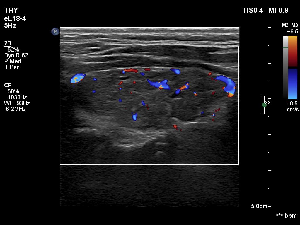 Right lobe, longitudinal scan