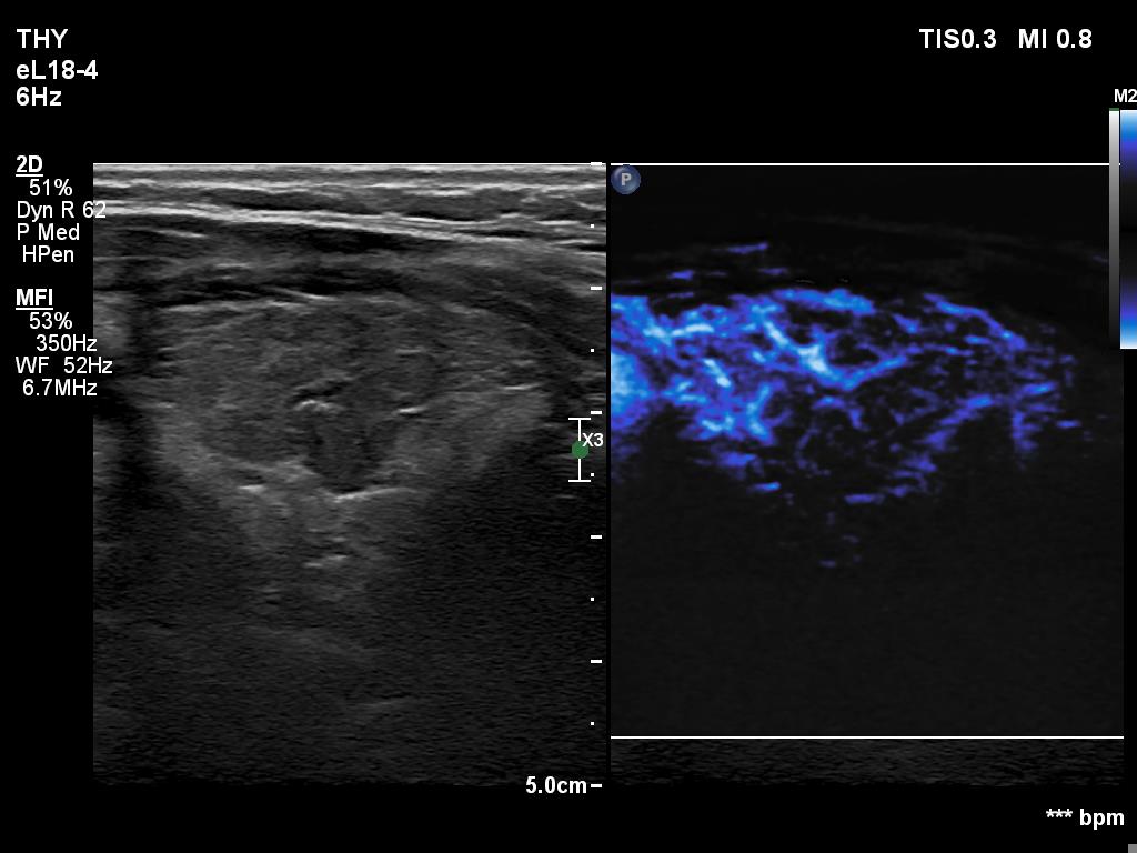 Right lobe, longitudinal scan