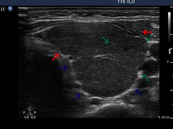 Right lobe, longitudinal scan