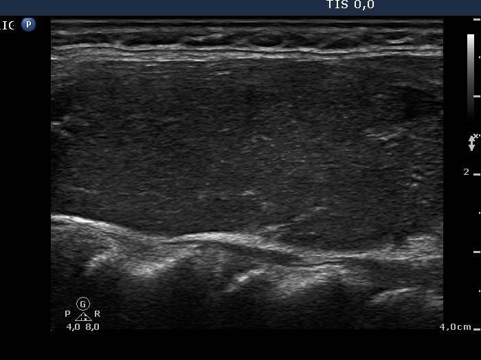 Right lobe, longitudinal scan
