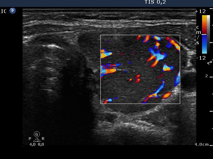 Right lobe, longitudinal scan