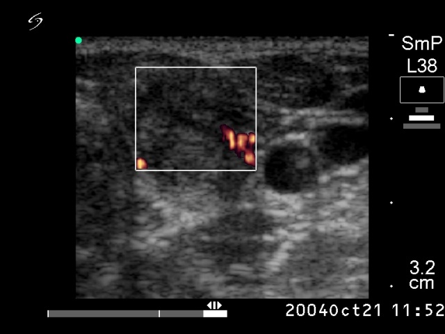 Right lobe, longitudinal scan