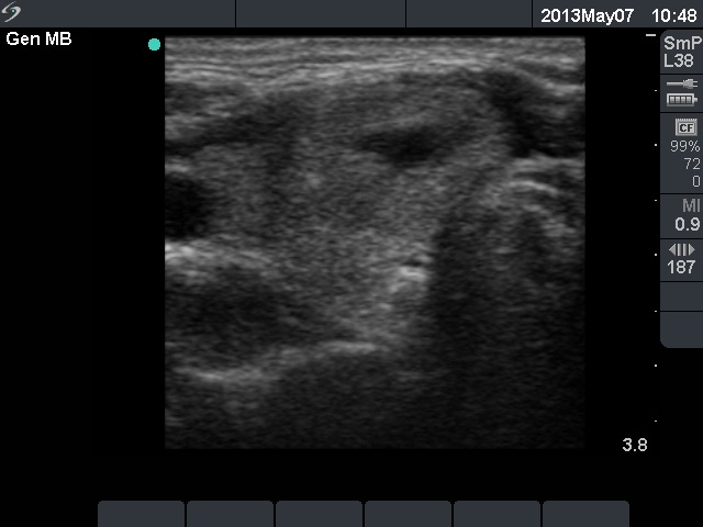 Right lobe, longitudinal scan